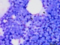 Acute myeloid leukemia