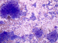 Metastatic thymoma (lung)
