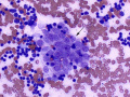 Metastatic thymoma (lung)