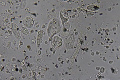 Urine casts