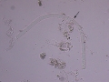 Waxy cast