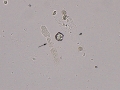 Granular and hyaline casts