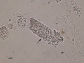 Granular & hyaline