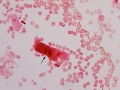 Hemoglobin casts (Prussian blue)