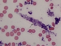 Hemoglobin casts (Wright's)