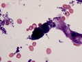 Hemoglobin casts (Wright's)