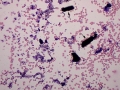 Hemoglobin casts (Wright's)