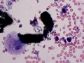 Hemoglobin casts (Wright's)