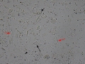 Hyaline cast