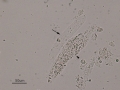 Granular & hyaline