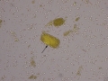 Hemoglobin cast