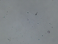 Hyaline cast