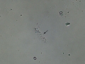 Hyaline cast
