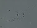 Hyaline cast