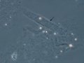 Hyaline cast