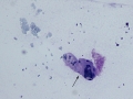 Hemosiderin (Wright's)