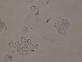 Waxy & epithelial