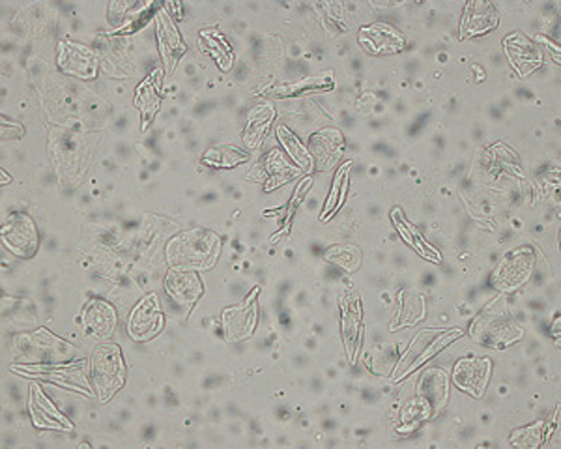 Transitional Epithelial Cells In Urine Deep Kitchen Sink