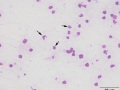 Dysmorphic red blood cells (line smear)