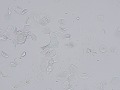 Squamous epithelial cells (wet prep)
