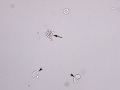 Neutrophil aggregates