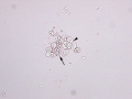 Neutrophil-epithelial aggregate