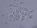 Neutrophil-epithelial aggregate & bacteria