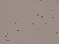 Hematuria