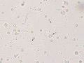 Inflammation & bacteria