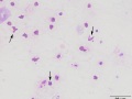 Dysmorphic red blood cells (line)