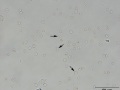 Dysmorphic red blood cells (wet prep)