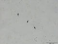 Dysmorphic red blood cells (wet prep)