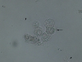 Urothelial carcinoma