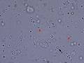 Epithelial cells & RBC & crystals & lipid