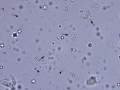 Epithelial cells & RBC & crystals