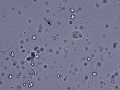 Epithelial cells & RBC & crystals & lipid