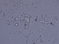 Epithelial cells & RBC & lipid