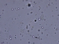 Epithelial cells & RBC & crystals & lipid