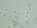 Urothelial carcinoma (wet prep, cat)
