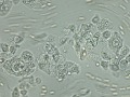 Urothelial carcinoma (wet prep, cat)