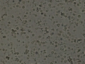 Hematuria