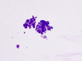 Neutrophil-epithelial aggregates (Wright's)
