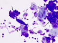 Neutrophil-epithelial aggregates (Wright's)