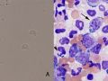 Lymphoma compilation
