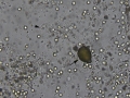 Hematuria