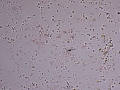 Pyuria & hematuria