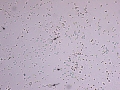 Pyuria & hematuria