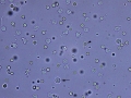 Pyuria & hematuria