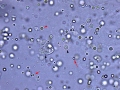 Pyuria & hematuria