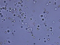 Pyuria & hematuria
